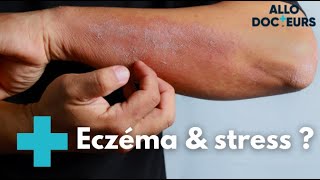 Eczéma  quelles solutions   Allo Docteurs [upl. by Kado]